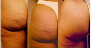 Dr Murad-Bodycare-cellulite-treatment