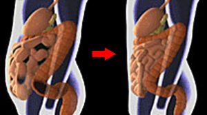 before-after-colonic
